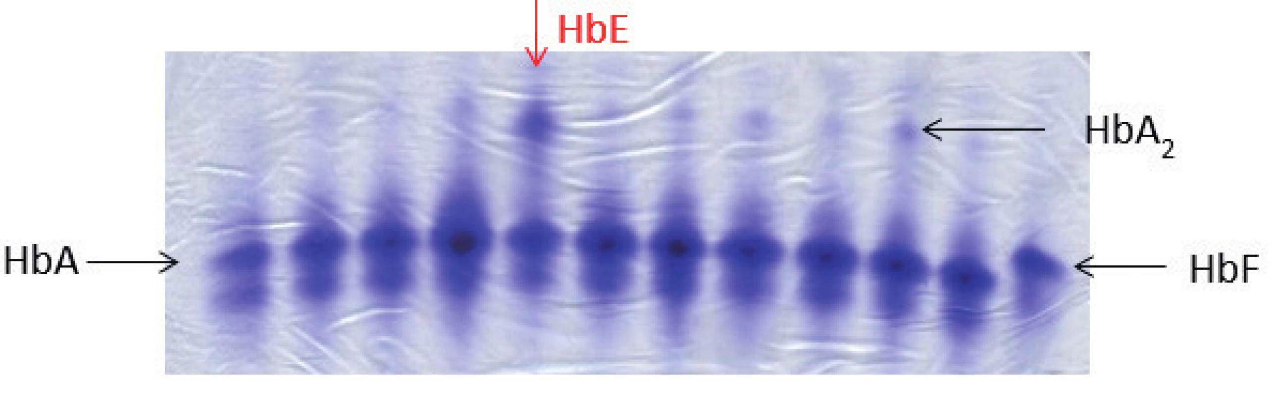 Elektroforéza Hb, polyakrylamidový gel barvený Coomasie blue. Na obrázku zobrazené jednotlivé frakce hemoglobinového spektra: HbA, HbF, u některých vzorků je patrná výrazněji frakce HbA₂, jedná se o nosiče β-talasemické alely. Červená šipka ukazuje pacienta s abnormálním hemoglobinovým spektrem, jedná se o nosiče alely pro HbE (hemoglobinová varianta s talasemickým fenotypem). HbE putuje stejnějako frakce HbA₂, k jeho potvrzení je nutná sekvenační analýza HBB genu. (M. Divoká, Hemato-onkologická klinika, FN a LF Univerzity Palackého v Olomouci)
Fig. 4. Hemoglobin electrophoresis in polyacrylamide gel stained with Coomasie blue. Hemoglobin electrophoresis showing the fractions of hemoglobin: HbA, HbF. More significant HbA₂ fraction in some samples demonstrates β-talasemia minor. The red arrow showing abnormal hemoglobin spectrum in a patient with hemoglobin E trait (hemoglobin variant with thalassemic phenotype). HbE fraction co-migrates with HbA₂. To confirm the Hb variant, HBB gene sequencing analysis is required.