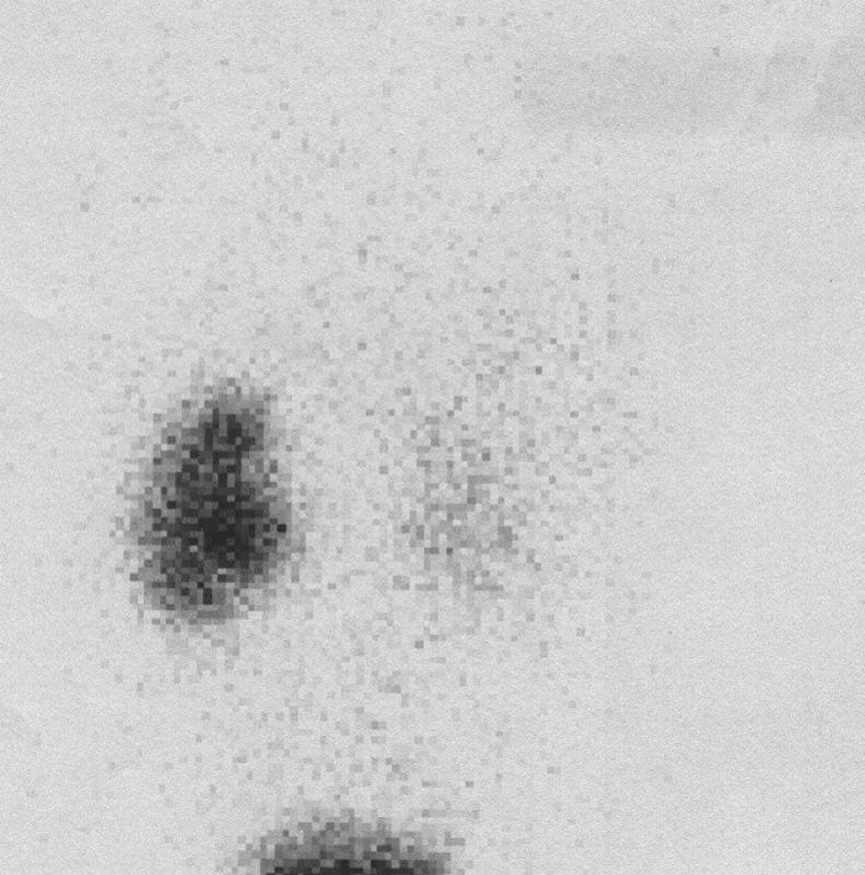 Kontrolní scintigram za 30 minut po skončení studie a po vymočení s retencí aktivity v dutém systému levé ledviny.
Fig. 11.A control scintigraphy 30min after the end of the study and after micturition with retention of activity in the hollow system of the left kidney.