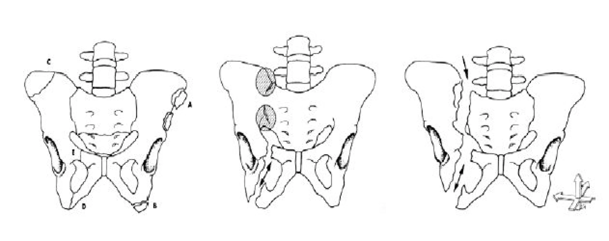 Fraktury pánve: dělení dle AO – typ A, B a C
Fig. 1. Pelvic fractures: division by AO – type A, B, C