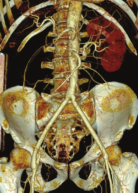 CTA kontrola po 4 letech od výkonu
Fig. 17: Follow-up CTA 4 years after surgery