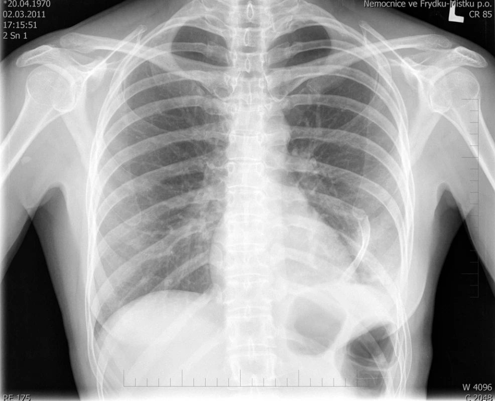 RTG plic po úrazu, patrná dislokace VIII. žebra vlevo, okraj fragmentu zlomeniny se promítá k srdečnímu hrotu 
Fig. 1. Posttraumatic lung x-ray, dislocation of the 8th rib on the left side. The rib fragment edge is located near the heart tip