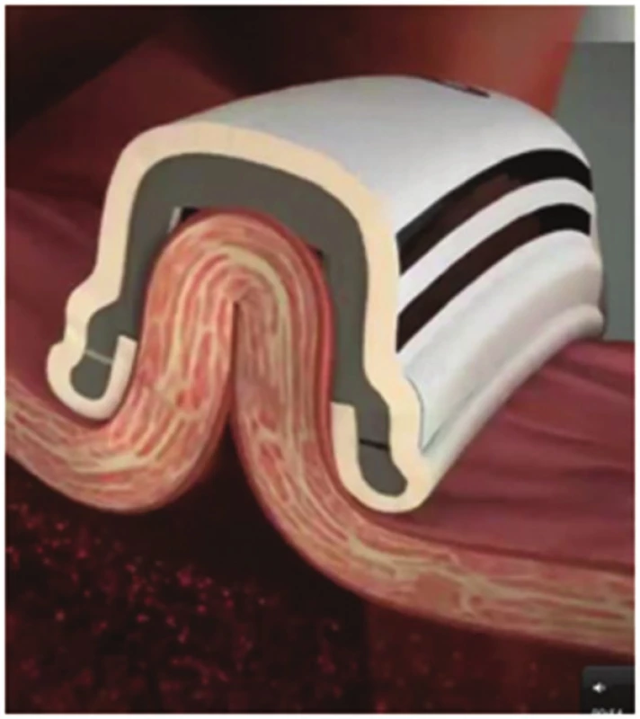 Průřez ablačním katétrem; myokard síně je nasán podtlakem do nitra sondy, mezi ablační elektrody
Fig. 2: Cross-section of the catheter; the atrial wall is sucked into the catheter, between the ablation electrodes