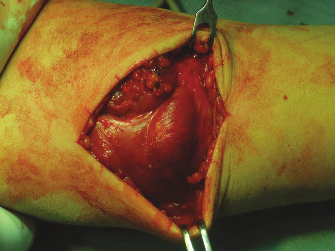Detail svalovej hernie predlaktia – peroperačný pohľad
Fig. 2. Detail view of the muscular forearm hernia – intraoperative view