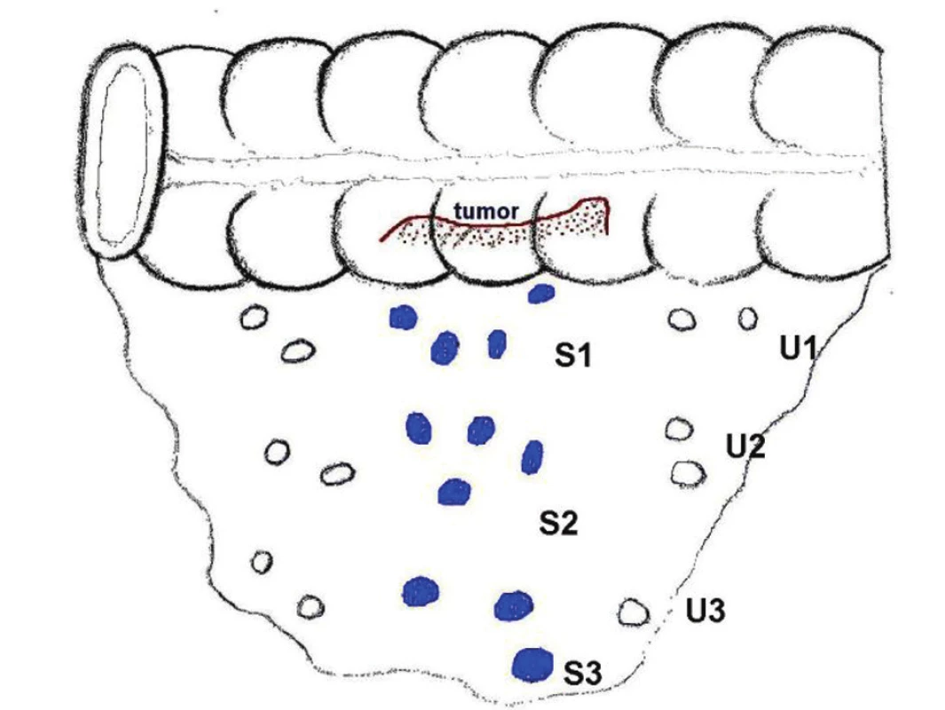 Schéma detekce SLN podle etáží
Fig. 1. A scheme of sentinel lymph node (SLN) detection in individual levels