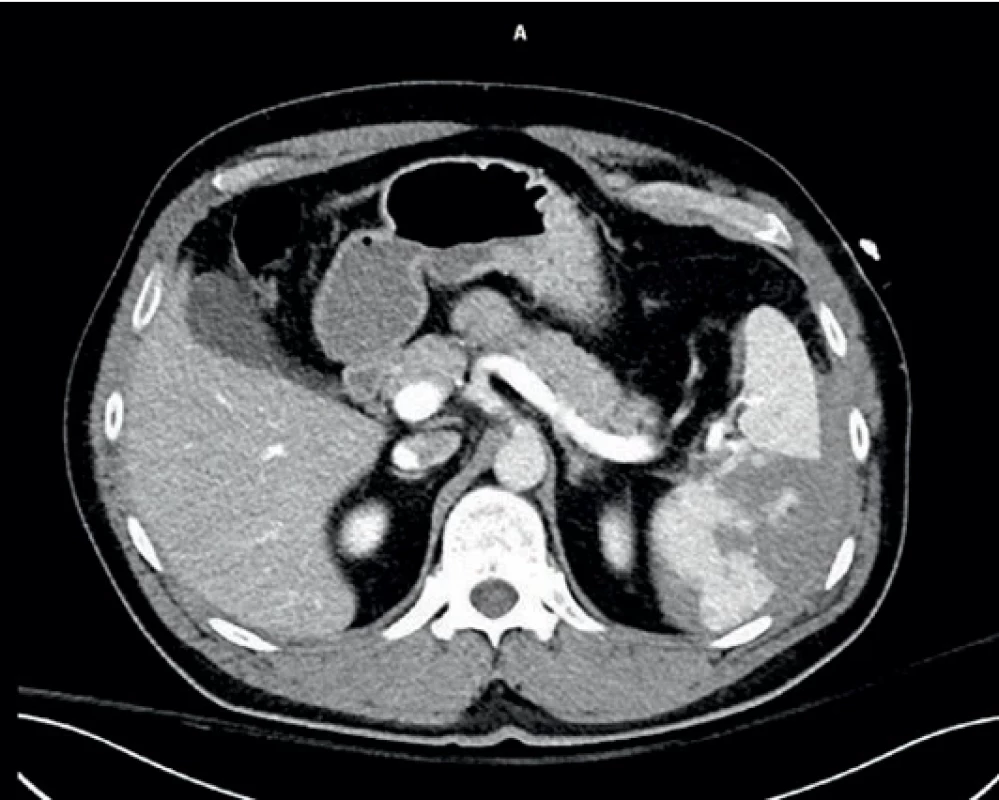  Úrazové CT prvního pacienta.  Injury CT scan of the fist patient.