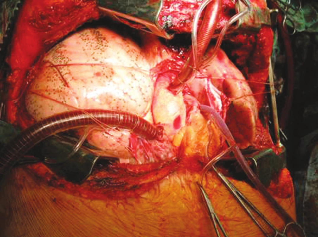 Technika transplantace plic, stav po implantací
Fig. 5.Lung tansplantation technique, the condition after the procedure