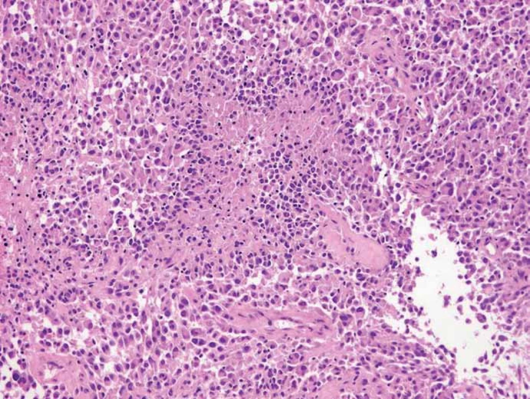 Gliom grade III (barvení hematoxylin-eozin).