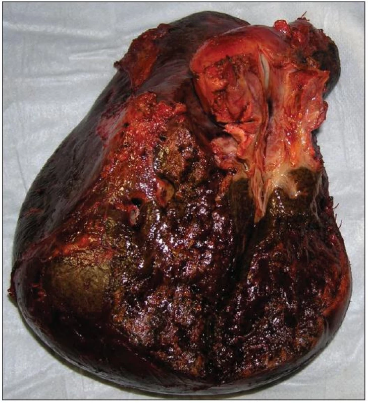 Resekát po pravostranné rozšířené hepatektomii s lobus caudatus pro Klatskinův tumor typu Bismuth IIIA
Fig. 9: Right extended hepatectomy with lobus caudatus for Klatskin tumor type Bismuth IIIA