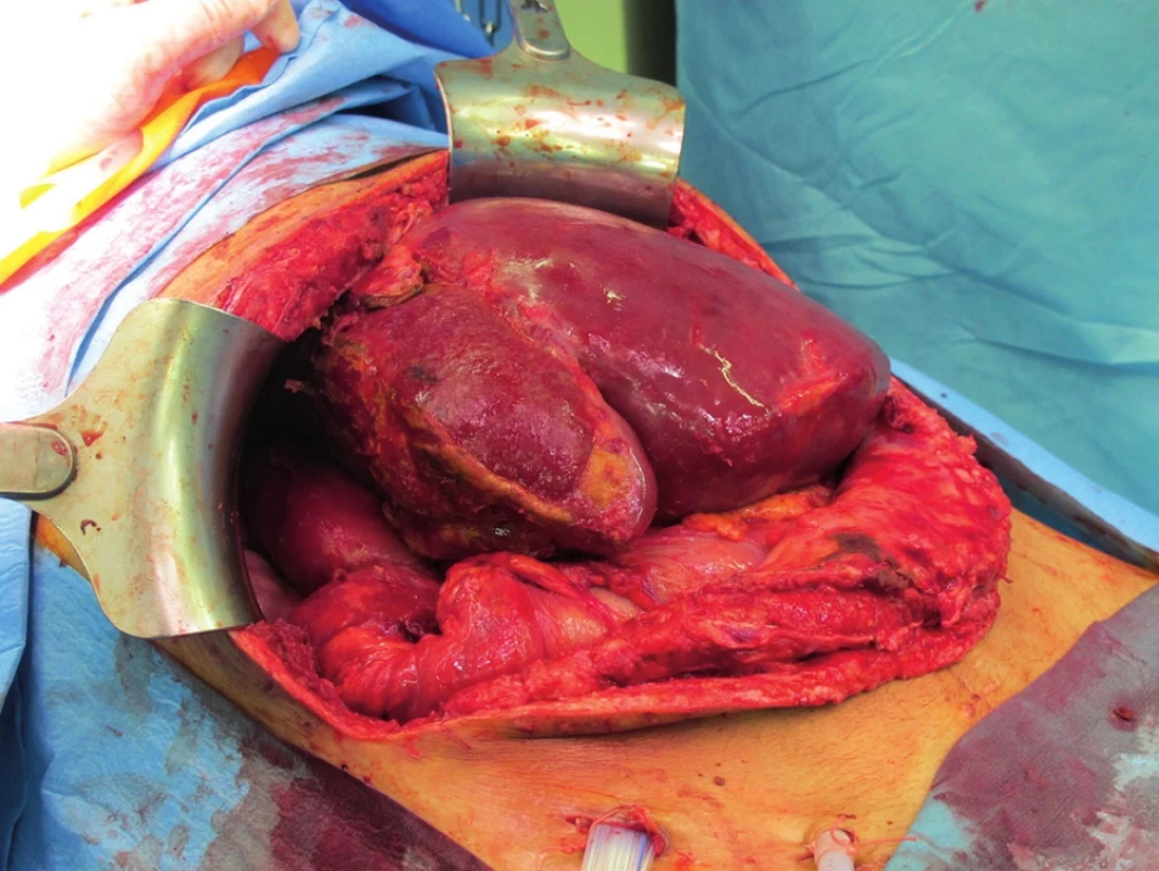 Hypertrofie levého jaterního laloku
Fig. 5. Hypertrophy of the left hepatic lobe