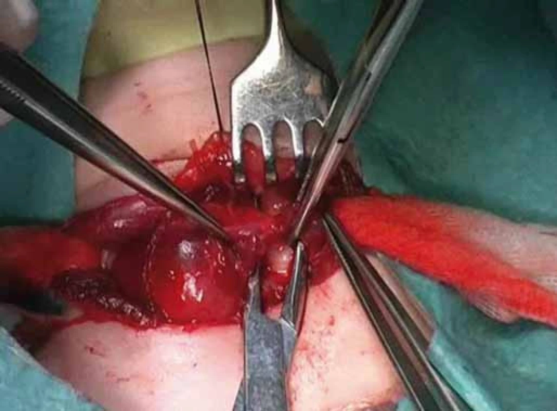 Right hemithyroidectomy.