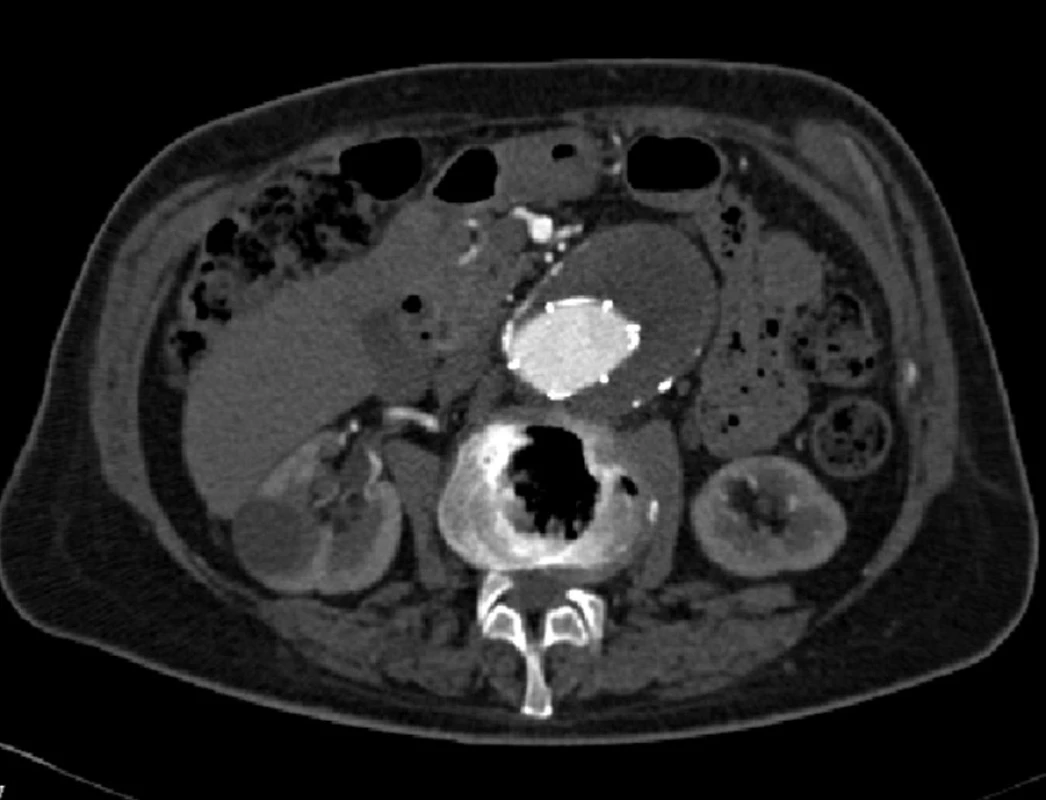 Kontrolní CTA 2008 bez průkazu endoleaku
Fig. 2: A control CTA 2008 without any evidence of an endoleak