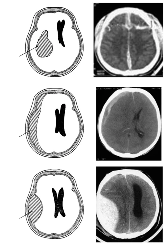 Typy hematomu při kraniocerebrálním poranění 
#1 Intracerebrální hematom vzniklý po průstřelu hlavy 
#2 Subdurální hematom chronického typu 
#3 Epidurální hematom vzniklý po pádu z kola
