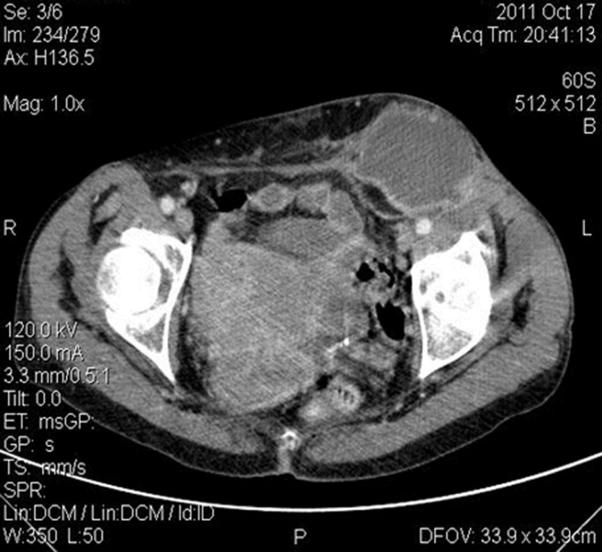 CT obraz abscesu v L třísle bez komunikace s dutinou břišní
Fig. 2: CT image of the left groin abscess without communication with the abdominal cavity