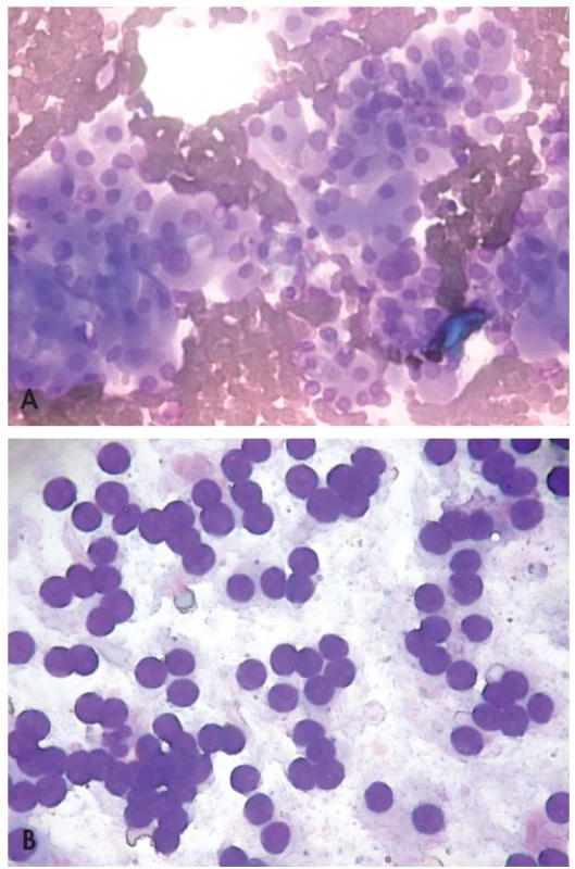Kategorie IV: Folikulární neoplazie nebo podezření z folikulární neoplazie