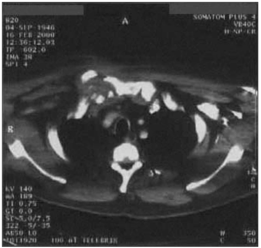 Osteomyelitis a osteochondritis pravého sternoklavikulárního kloubu s infiltrací horního mediastina, plicní tkáně a pravých pektorálních svalů u 54letého muže s 10letou anamnézou DM 2 léčeného PAD, st.p. vysoké amputaci dolní končetiny a amputaci prstů druhé nohy pro diabetickou gangrénu.