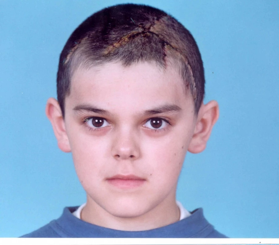 Stav tři týdny po lalokových posunech v oblasti hlavy