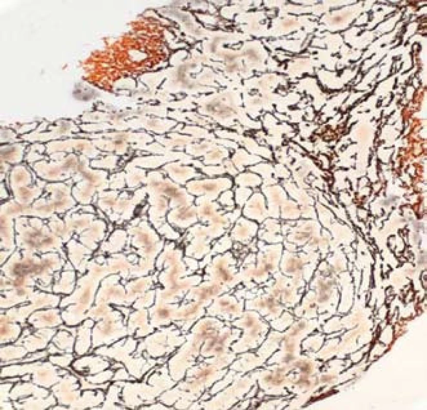 Histopatologický nález jaterní biopsie. A – barvení hematoxylin-eozin; B – speciální barvení na retikulin.