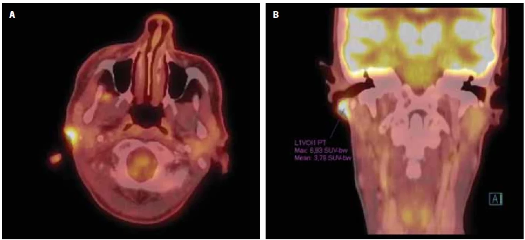 Reziduum tumoru u zevního zvukovodu vpravo s akumulací fl uorodeoxyglukózy na vyšetření PET/CT s odstupem 3 měsíců po reiradiaci pro progresi.