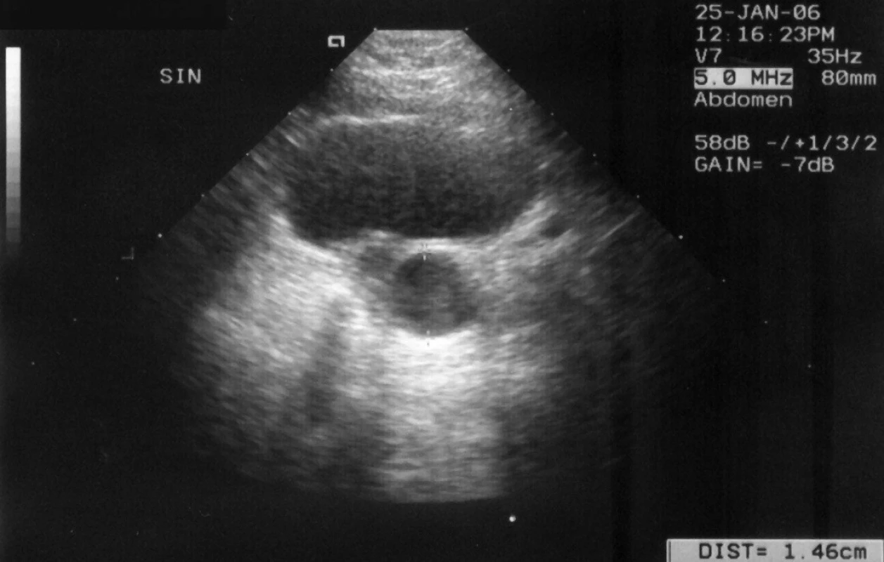 Kazuistika č. 3. UZ zobrazení močového měchýře a dilatovaného vinutého ureteru v distálním úseku šíře 14,6 mm.
Fig. 6. Case report 3. US image of urinary bladder and dilated wind ureter in distal segment of 14.6 mm width.