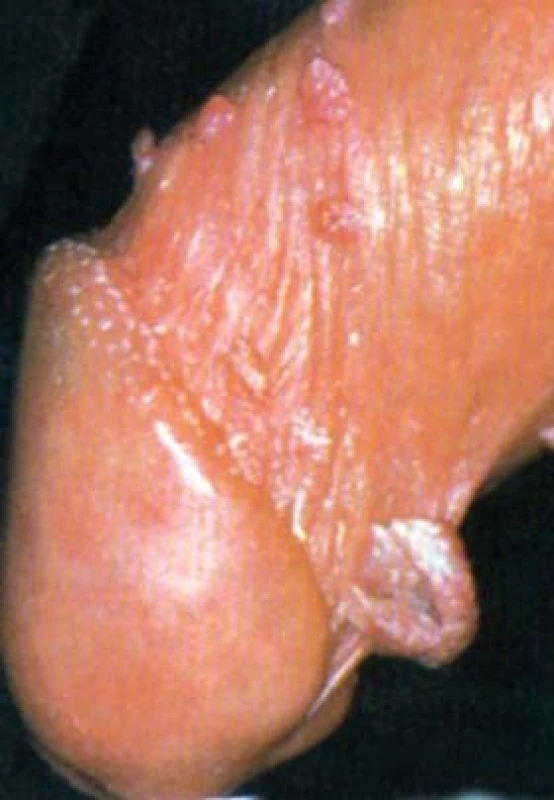 Kondylomata.