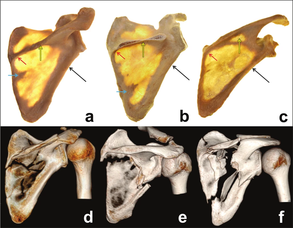 Architecture of the scapula and the course of fracture lines
a – transilluminated scapula, posterior view; b – transilluminated scapula with resection of scapular spine, posterior view; c – transilluminated scapula, posteroinferiorview; d – fracture of spinal pillar; e – fracture of lateral pillar; f – fracture of both pillars. Red arrow – spinomedial angle, yellow arrow – central weakened area, black arrow – circumflex notch (weakened area of lateral pillar), blue arrow – horizontal muscular septum.