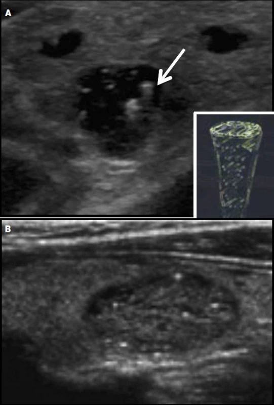 Koloidní agregace v cystoidu (A, comet tail artefact) a spongiformním (B) uzlu.