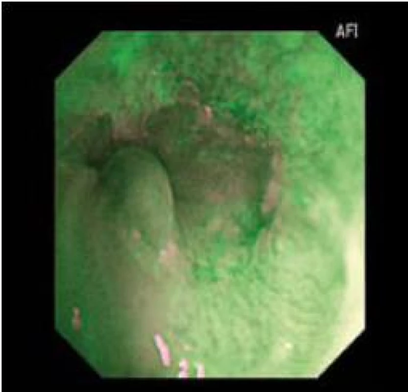 Falešně pozitivní AFI u nedysplastického BJ.
Fig. 8. Falsely positive AFI with non-dysplastic BJ.