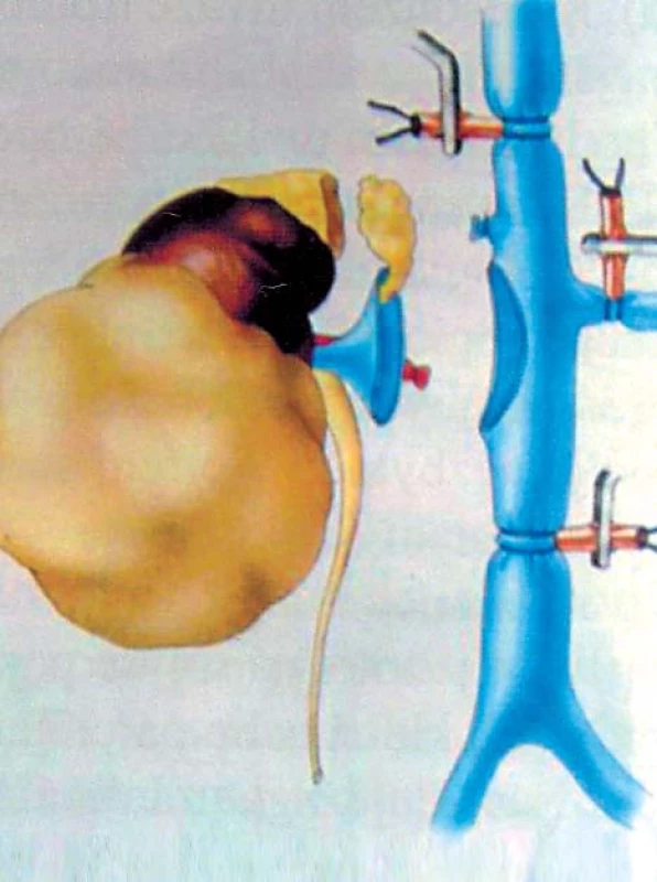 Tumor pravé ledviny s trombem, hladina II (resekce DDŽ) [24].
