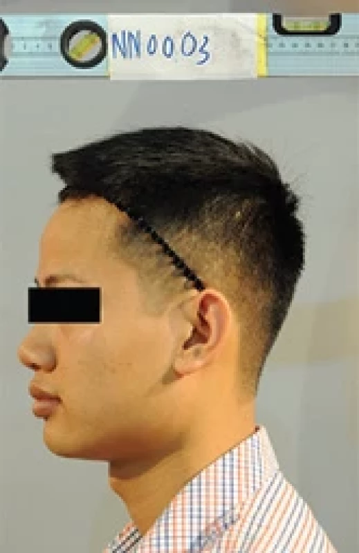 Photographic setup. Participants sat upright on a chair with their Frankfurt horizontal plane parallel to the fl oor and removed any ear accessories. They faced the camera and then turned right by 90 degrees. A ruler was placed 3 cm above the head as a reference point for the DENTAVN program.
