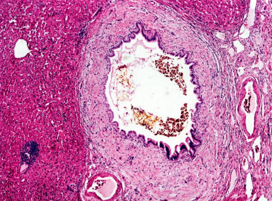 Dilatované žlučovody s hepatolitiázou, HE 20x
Fig. 4. Dilated bile ducts with hepatolithiasis, HE 20x