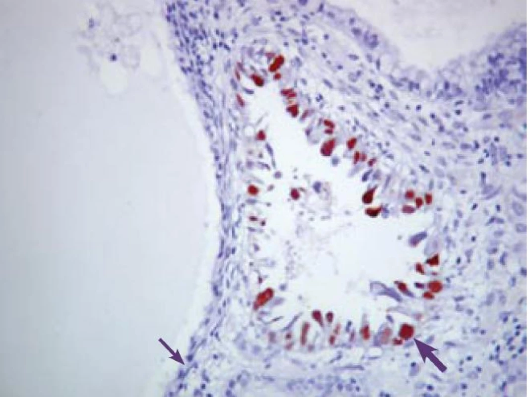 Detekci a Ki- 67 (červenohnedo) v SC (hrubá šípka). Neprítomnosť expresie Ki-67 v cystickom AE (v menopauze) (tenká šípka). Imunohistochemické vyšetrenie s protilátkou proti Ki-67. ABC- Px, 200×.