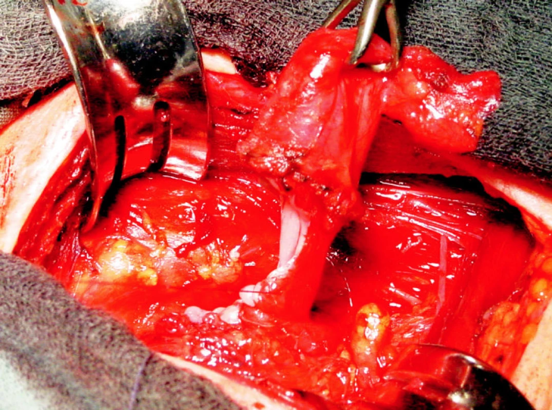 Resekce Zenkerova diveriklu
Fig. 3. Resection of the Zenker’s diverticle