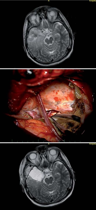 Transkortikální transtemporální přístup (vč. temporální resekce nádoru).
Fig. 6. Transcortical transtemporal access (including temporal resection of the tumour).