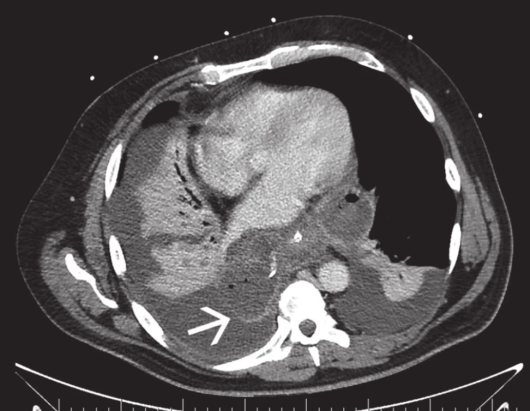 Absces mediastina
Fig. 4. Abscess of the mediastinum