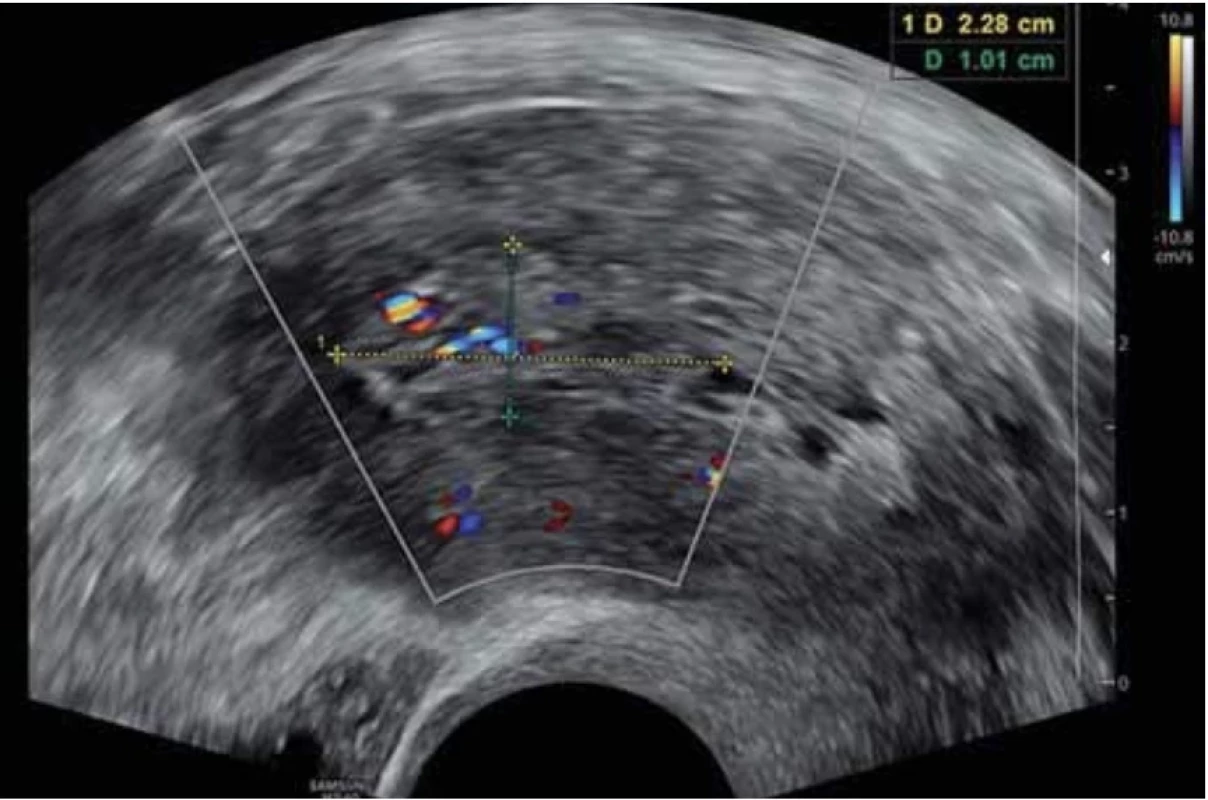 ásobení endometriálního polypu z jedné přívodné cévy bez větvení. // Single dominant vessel without branching of endometrial polyp.