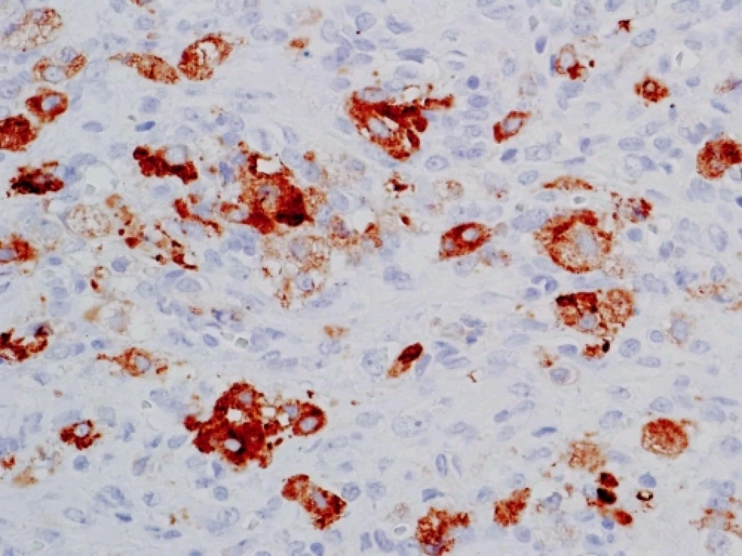 Imunohistochemický průkaz inhibinu (zvětšeno 400x)