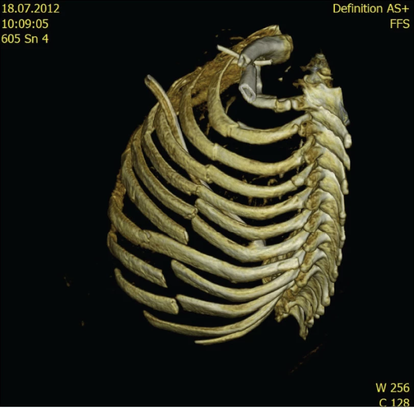 Dislokace žeber u blokové zlomeniny (3D rekonstrukce MDCT)