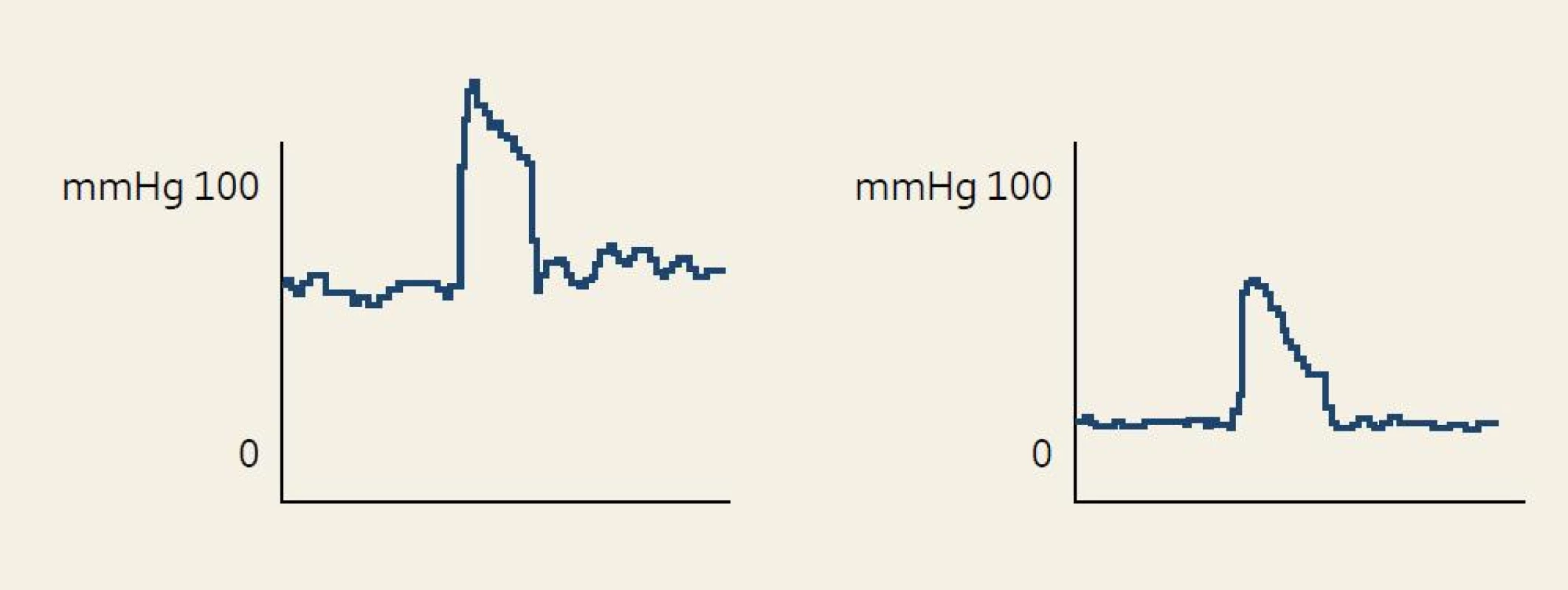 Rozdíl manometrického záznamu análního tlaku při testu sevření u zdravého pacienta (vlevo) a pacienta s inkontinencí stolice (vpravo).
Fig. 1. Difference of anorectal manometry record, squeeze pressure in healthy patient (left) and pacient with fecal incontinence (right).