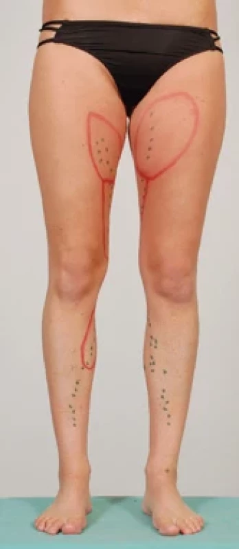 Planning of LVAs on the left thigh of patient No. 12.
