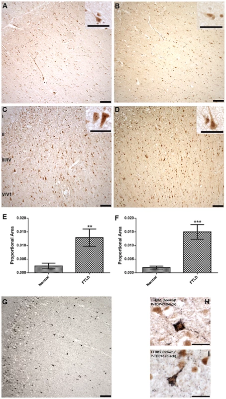 Upregulated Tau tubulin kinases are also co-expressed with phospho-TDP-43 pathology.