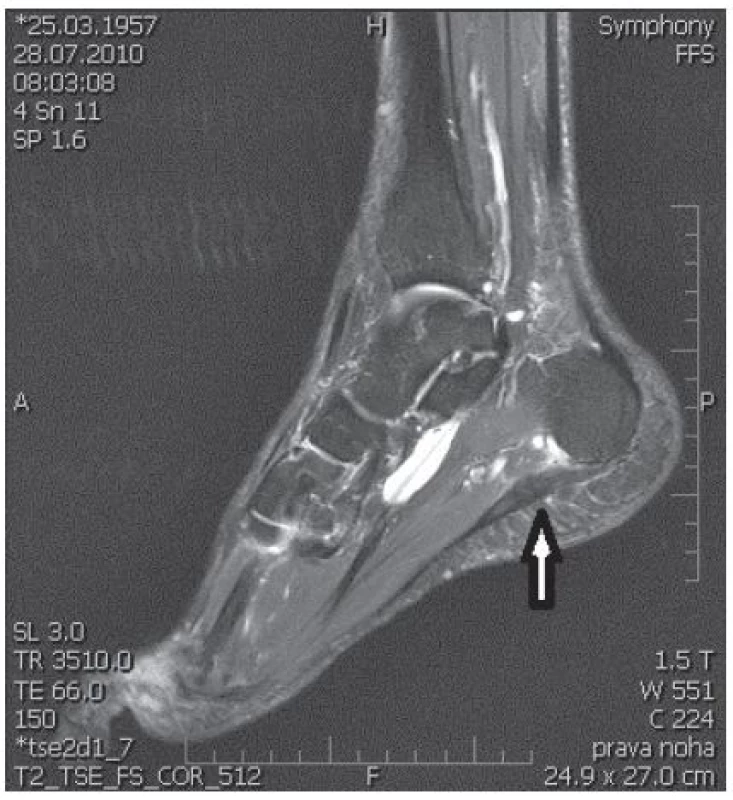 T2-vážené zobrazení magnetickou rezonancí. Šipka ukazuje zesílení a hyperintenzitu plantární fascie, navíc přítomna tendosynovitida šlachy m. flexor hallucis longus. (Snímek zapůjčen z archivu Radiologické kliniky Nemocnice Na Homolce.)