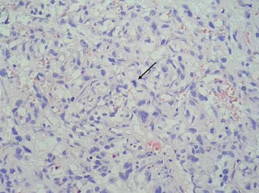 Histologický preparát.
Barvení hematoxilin + eozin, zvětšení 400×. V nádorovém infiltrátu výrazná nukleární pleomorfie, šipkou označena atypická mitóza.