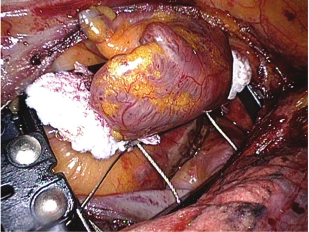 Ouško levé síně uzavřeno v systému AtriClip, před uvolněním zaváděcího systému; pod ouškem viditelná ablační léze
Fig. 4: Left atrial appendage is occluded by the AtriClip system, just before releasing the deploying system; the ablation lesion is visible under the appendage