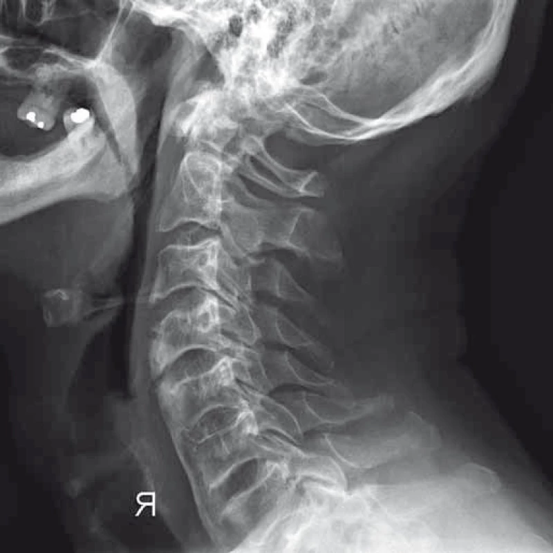 Kontrolní RTG po šesti měsících (kazuistika 2).
Fig. 9. Follow-up X-ray after six months (a case report 2).