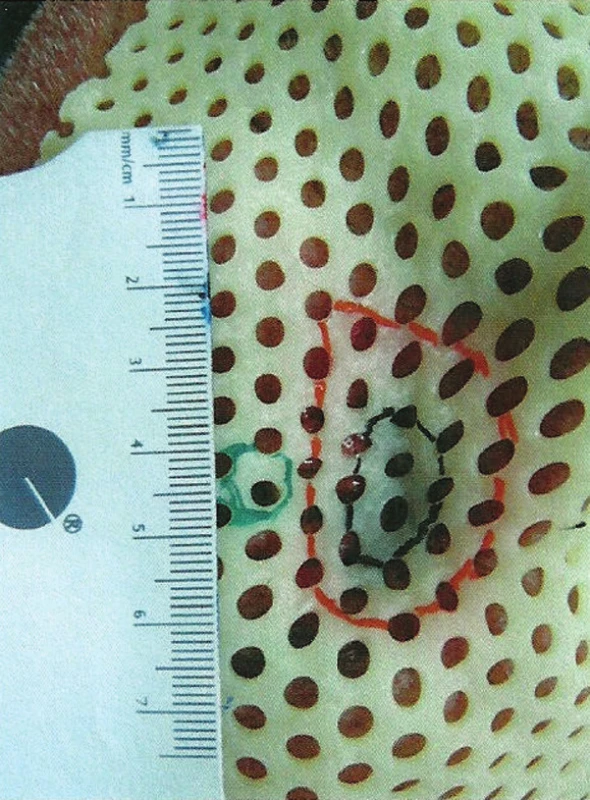 Uloženie ochrany na povrchu očnej gule (Tungsten eye shield)