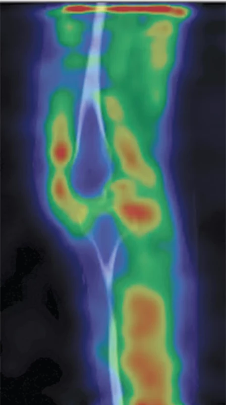 Fúze SPECT/CT levého kolenního kloubu v sagitálním řezu v časné fázi, kde je zvýšený krevní pool v oblasti synovie (stejný obraz byl i na pravém kolenním kloubu).