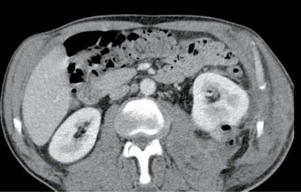 Drobný ledvinný absces levé ledviny s ložiskem plynu
Fig. 6. Slight abscess in left kidney with gas deposit