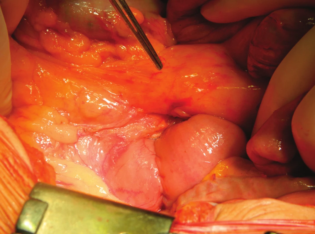 Anastomóza duodenojejunální, retromezenterická, dvouvrstevná
Fig. 2: Duodenojejunal anastomosis, continual suture, two-layer, retromesenteric aproach