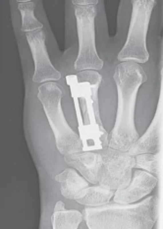 Lateral X-ray detail of the internal distractor fi xed with cortical screws during distraction process.