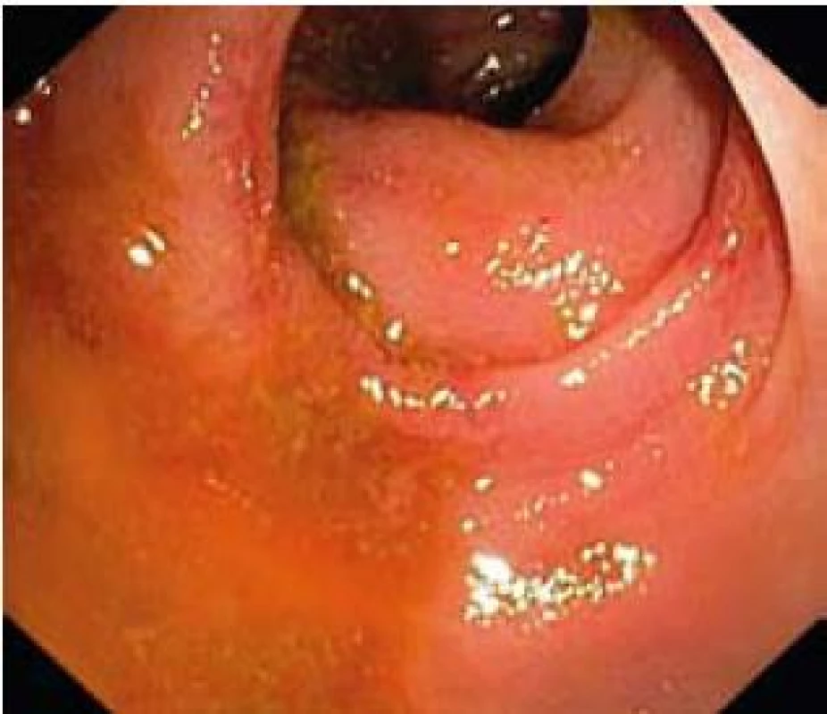 Klidová fáze ulcerózní kolitidy s granulovanou sliznicí a nepřítomností cévní kresby (Mayo skóre 1).
Fig. 2. Ulcerative colitis in quiet phase with mucosal granularity and decreased vascular pattern (Mayo score 1).